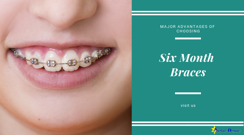 Here are some of the advantages of choosing six month braces. Learn more. stellardentalllc.com/blog/6-major-a… #dentalbraces
