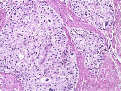 DStrovski's tweet photo. Urothelial carcinoma, called transitional cell carcinoma, occurs in the cells that line the inside of the bladder. Urothelial cells expand when your bladder is full and contract when your bladder is empty. https://t.co/oy7Z2CC1gm