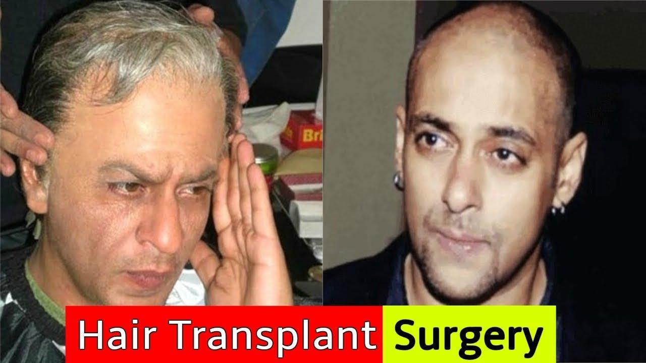 Where did Salman Khan get his hair transplant  Quora