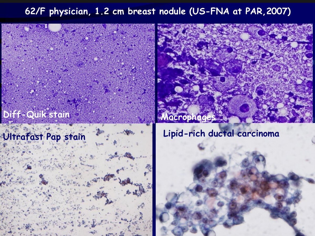 gracechyang's tweet photo. Macrophage-like cells turned out to be cancer #IACwebinar https://t.co/ToTXXmNcKg