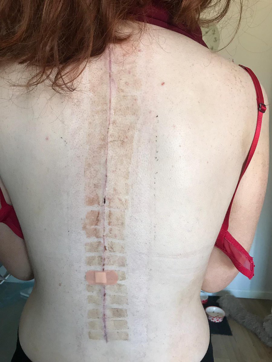 PinkConfettiLE9's tweet photo. #OperationLive our daughter had this operation in Feb at the same age,  its amazing to see what she went through 😲 more so as how shes recovered 💕 great show.. well done Izzy hope Chloe does as well xx https://t.co/9u2fJyC4y7