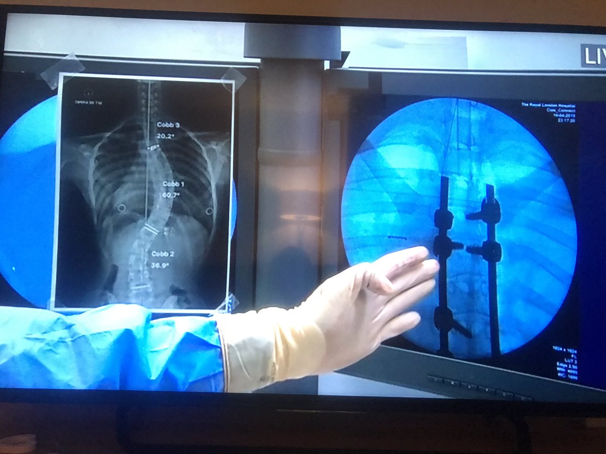 Just, WOW! 

So, lets get this ‘straight’.... Chloe’s spine has gone from a 60 degree curvature to this ....?!

Simply amazing. ‘Spine tingling’ even! Who agrees? 

What an incredible team of #NHSHeroes. Hats off to you Arun and team!

#OperationLive