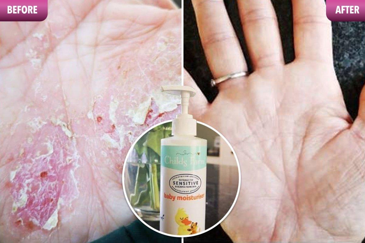 Woman cures her red raw hands with £5 shea butter baby moisturiser from Superdrug thesun.co.uk/fabulous/88368…