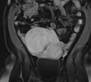 DkimMD's tweet photo. Large uterine fibroids successfully treated with uterine fibroid embolization via transradial approach #TRUFE #ufe @kavaliIR @maninbsir @WashUIR @DrGiardinaIR @rramaswamy @ChrisDMaloneVIR @SIRRFS @SIRspecialists @JVIRmedia @CVIR_Journal @cirsesociety https://t.co/QIc9Gwow8z