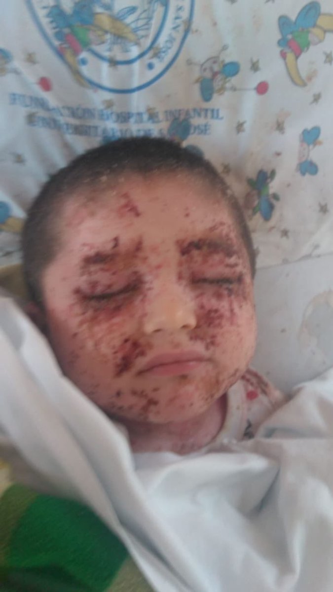 alexandramonto's tweet photo. Este niño se llama Rafael, su papa Felix Eduardo Pinilla esta encadenado esperando que la EPS Servisalud le entregue el medicamento para la piel de su hijito. La EPS dice que no, porque es de uso cosmético, que tal? https://t.co/dkAn8v2oD2