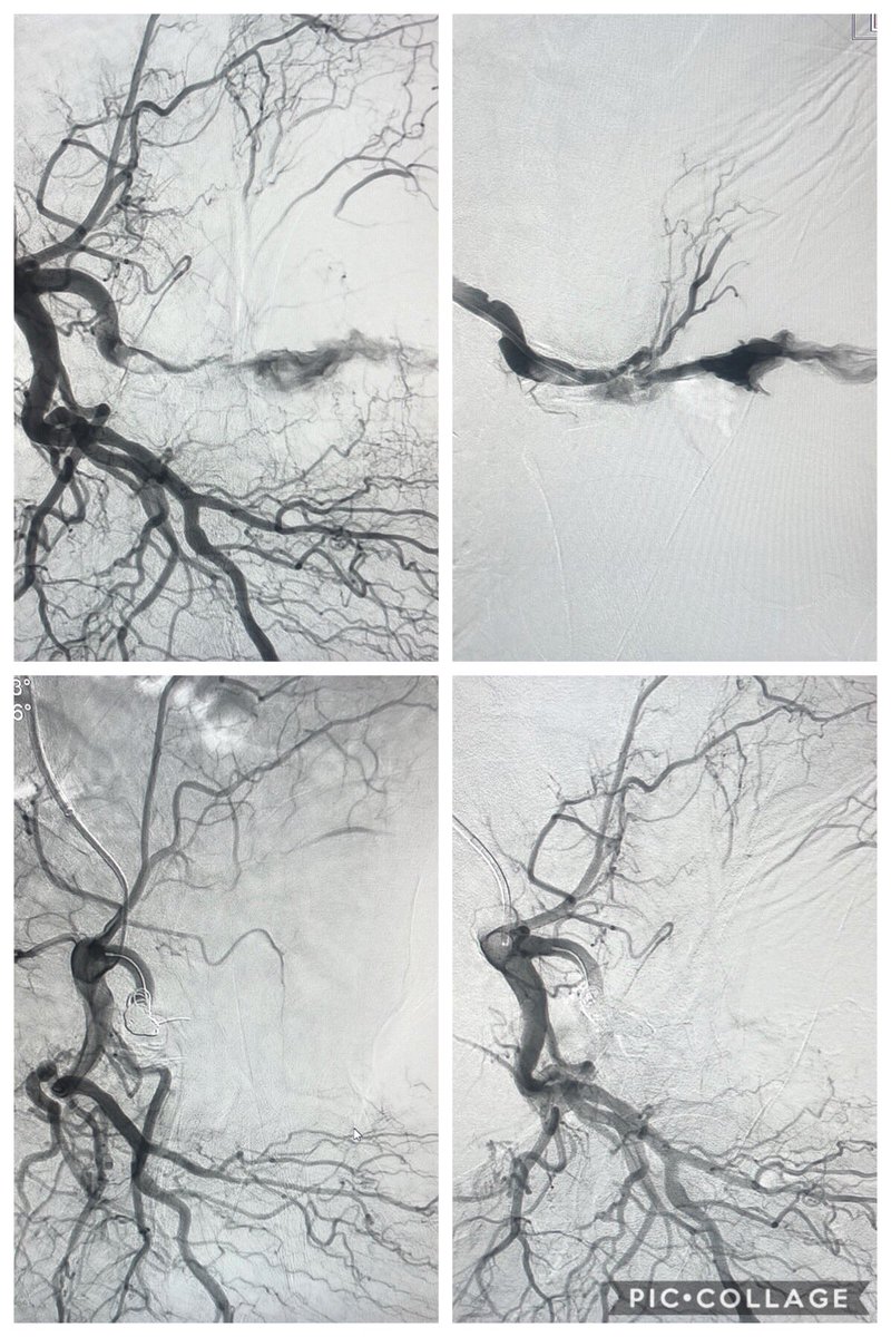 Last nights call case. Patient stabbed in butt. IR to the rescue with large coils. #AVIR #iRad #IamIR