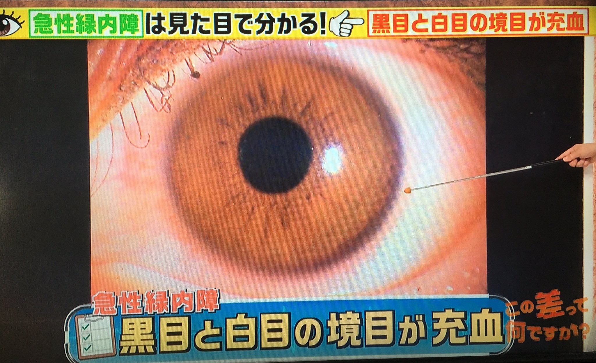 טוויטר ゆうゆ בטוויטר 緑内障の簡単なセルフチェック 最初の画像を表示し スマホをいつも見ている距離に持って 左手で左目を覆って隠し 右目でマス目の真ん中にある白い点を10秒間見ます 数字やマス目が欠けていたら 緑内障の可能性あり 両目やる