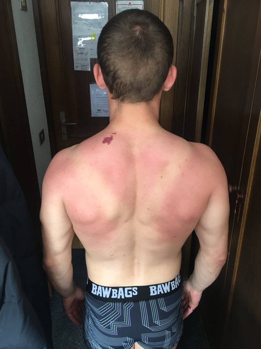 murraybuchan's tweet photo. Maybe underestimated the sun yesterday. Shovelling snow of the airbag in just my bib pants was a bad idea! @Bawbags #KookedIt https://t.co/HWOcOLCshd