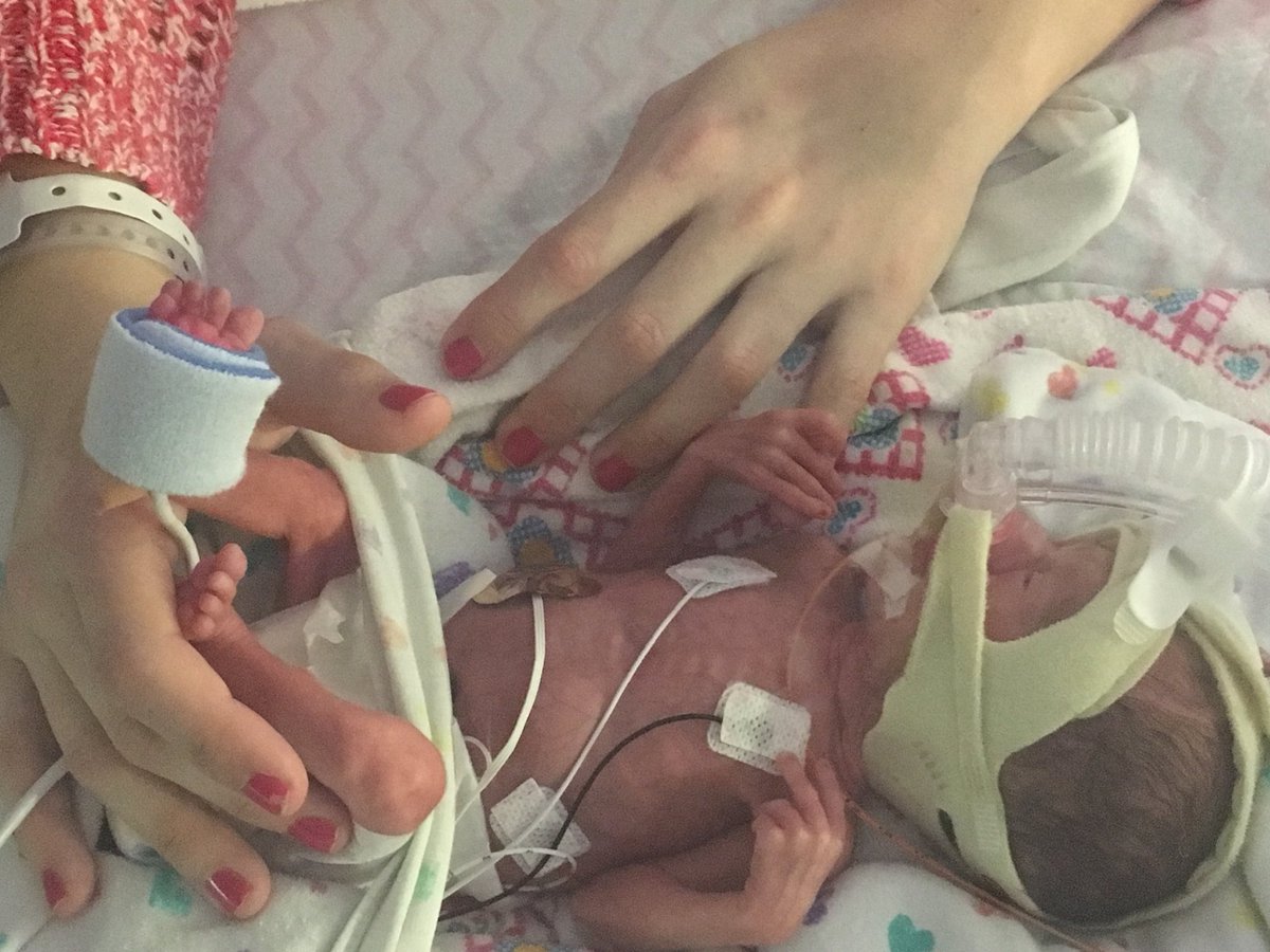 fromminitomoose's tweet photo. #Tbt of #maddiemoose who was born at #27weeks and is now #three Our #littlewarriors amaze us everyday! #NICU #nicubaby #nicucommunity #preemie #preemiebaby https://t.co/KuMxFbFvBE