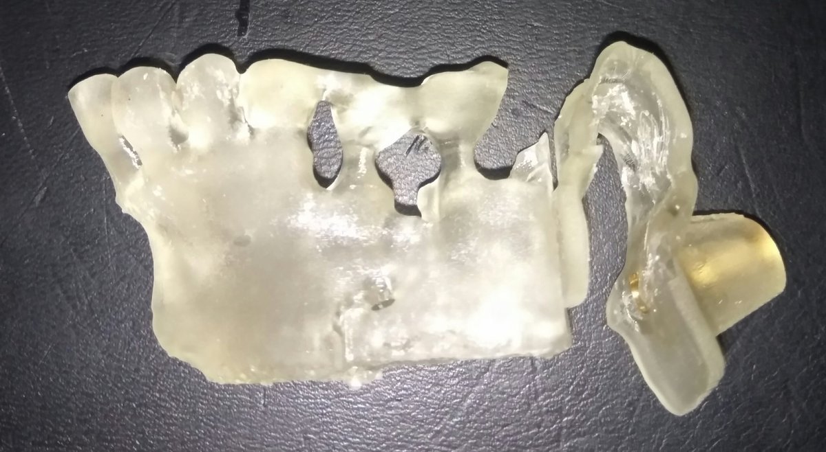MM3D_'s tweet photo. Personalized surgical guide to improve surgical intervention.
#planificaciónquirúrgica #guiaquirurgica #dentist #dentalschool #3DPrinting #medicalmodel3d #custom #surgeryplanning https://t.co/IW8iDMJPOO