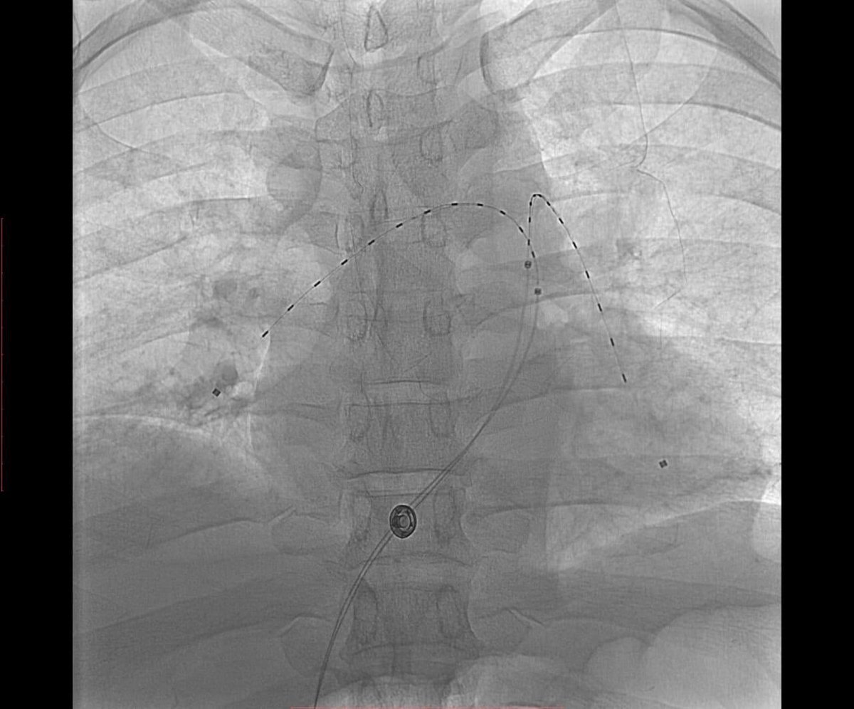 بإستخدام جهاز إذابة الجلطات بذبذبات الموجات الصوتية على فترة 8 ساعات 
بفضل الله #مجمع_الملك_عبدالله_الطبي بجدة .. ينقذ حياة أربعيني سقط من إرتفاع عالي .