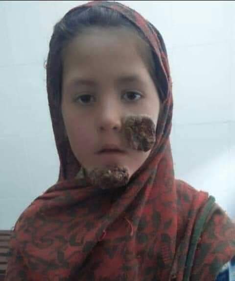 AlKhurramPk's tweet photo. یہ بیماری وزیرستان مین دن  دن بڑھ رہی ہے خدارا کوئی نوٹس لے
پھول جیسے بچے ضائع ہو رہے ہیں ہمارے https://t.co/w17XTi6g3c