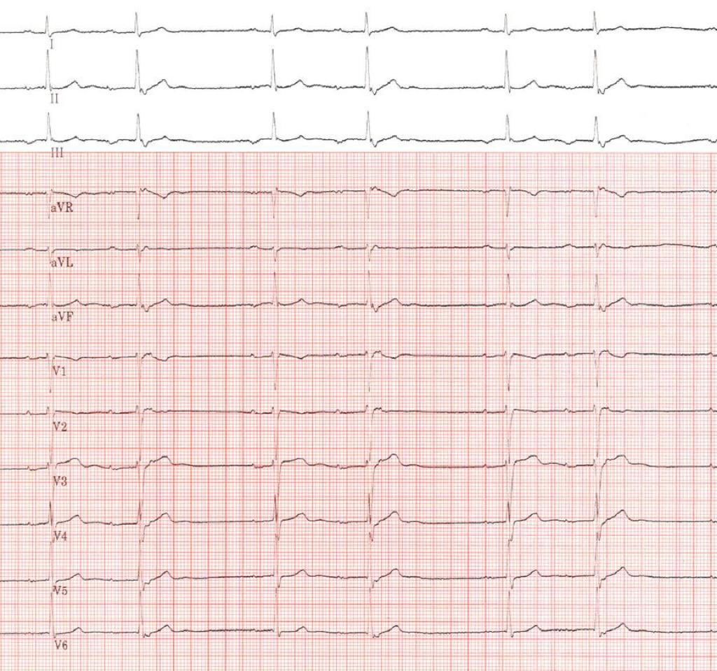 Avnrt explained in a single ECG #EPeeps