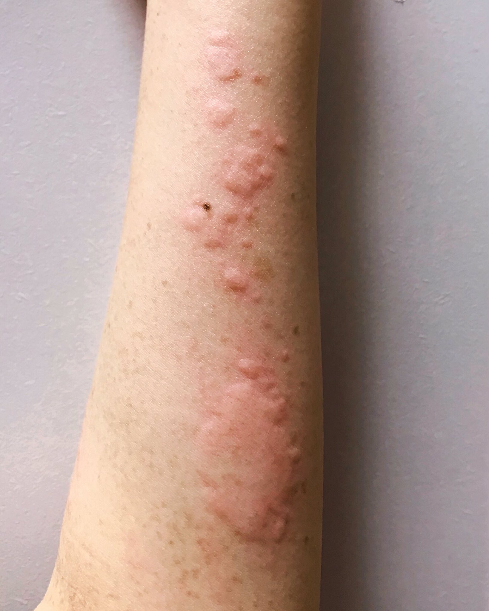 や ま か わ ま す み Twitterissa なんかめちゃんこ蕁麻疹出た 腕と足と首と背中と耳 12時間くらいしたら 跡形もなく消えて無くなった 蕁麻疹 じんましん 痒い