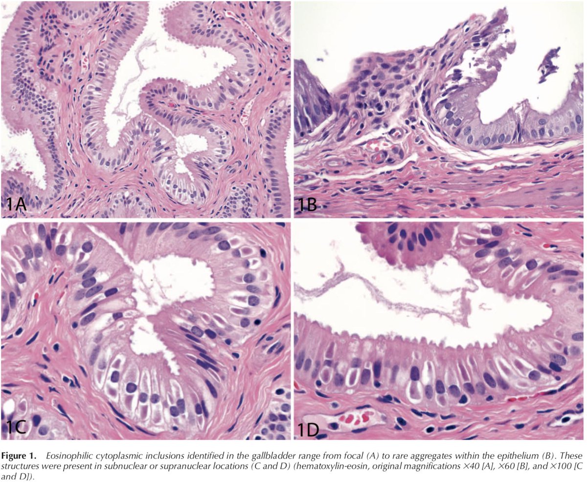 ArchivesPath's tweet image. Now #EarlyOnline by Rose et al. Cytoplasmic Fibrillar Aggregates in Gallbladder Epithelium Are a Frequent Mimic of Cystoisospora in Pediatric Cholecystectomy Specimens. Free full text: buff.ly/2GgZgD6 #gipath #pedipath