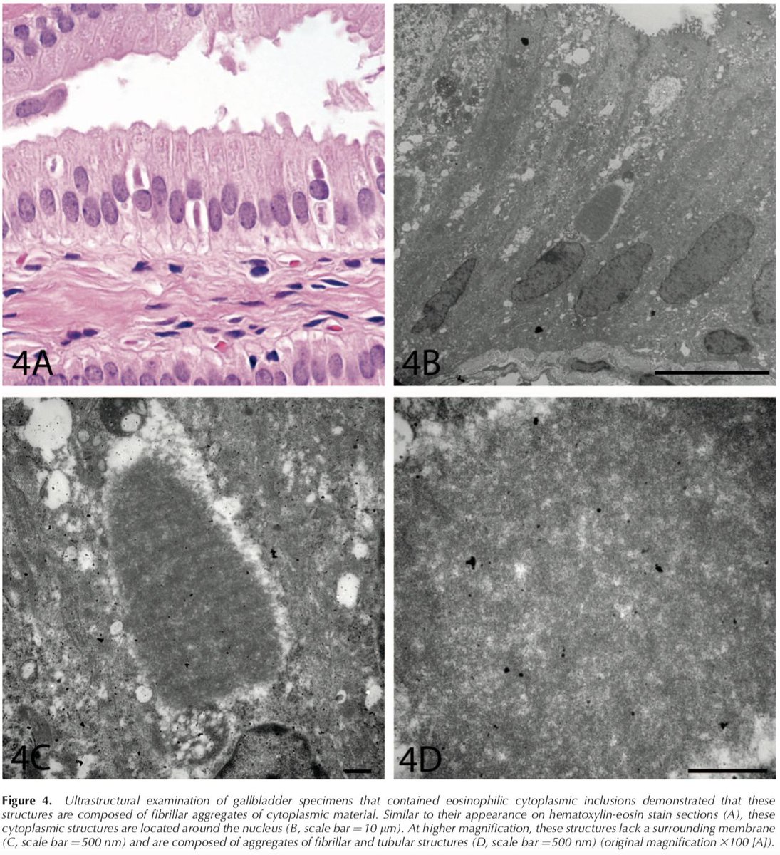 ArchivesPath's tweet image. Now #EarlyOnline by Rose et al. Cytoplasmic Fibrillar Aggregates in Gallbladder Epithelium Are a Frequent Mimic of Cystoisospora in Pediatric Cholecystectomy Specimens. Free full text: buff.ly/2GgZgD6 #gipath #pedipath