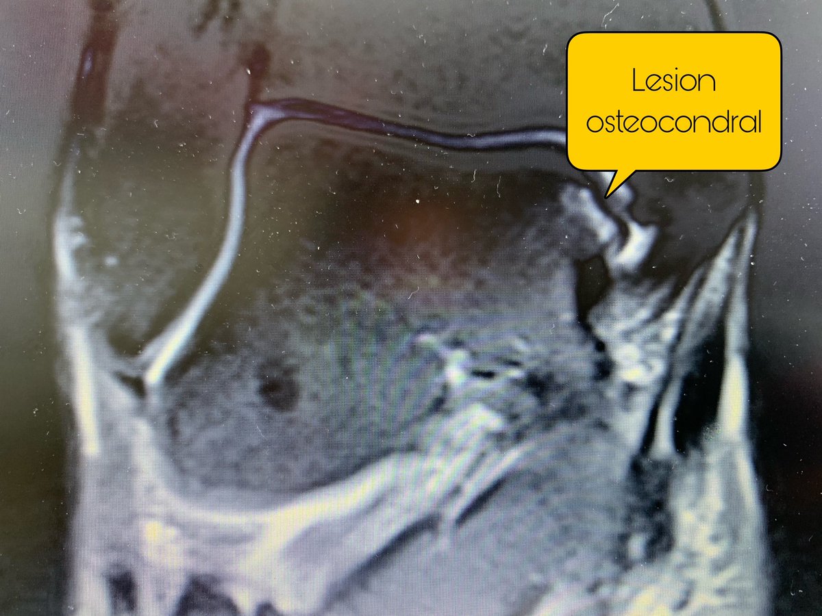 dr_jtejada's tweet photo. 3 semanas postop, lesion osteocondral astragalo tratada con chondrofiller.
Gran trabajo de fisioterapia!!👏👏@qmoyas @trainingtherapy @ClinicaNavarra @SilberbergDr #ankle #surgery #arthroscopy https://t.co/VW7uArxOFG