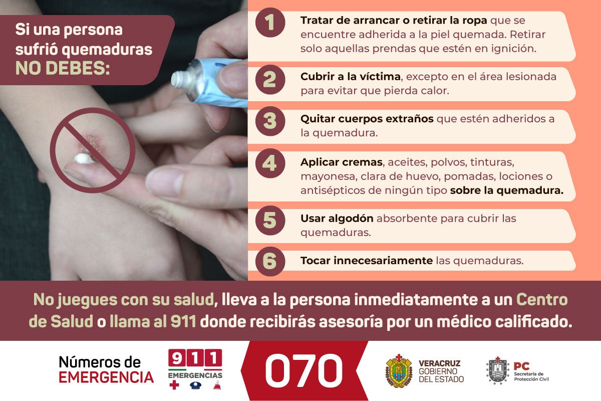 SSALUDVeracruz's tweet photo. Una quemadura es un tipo de lesión de la piel u otros tejidos, de acuerdo a su extensión se clasifican en menores, moderadas y graves. 

Ante ésta situación acude a tu unidad médica 😉 https://t.co/oK0awp0mcw