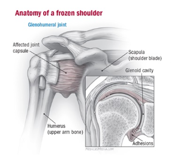 MichelleLMTRCST's tweet image. Restrictions in shoulder muscles may be more than tight muscles. Within every joint capsule, slight fascial adhesions can occur, build and cause restrictions. I use myofascial massage to restore surrounding muscles. #sportsmassage #enduranceathletes #trainingrecovery #recovery