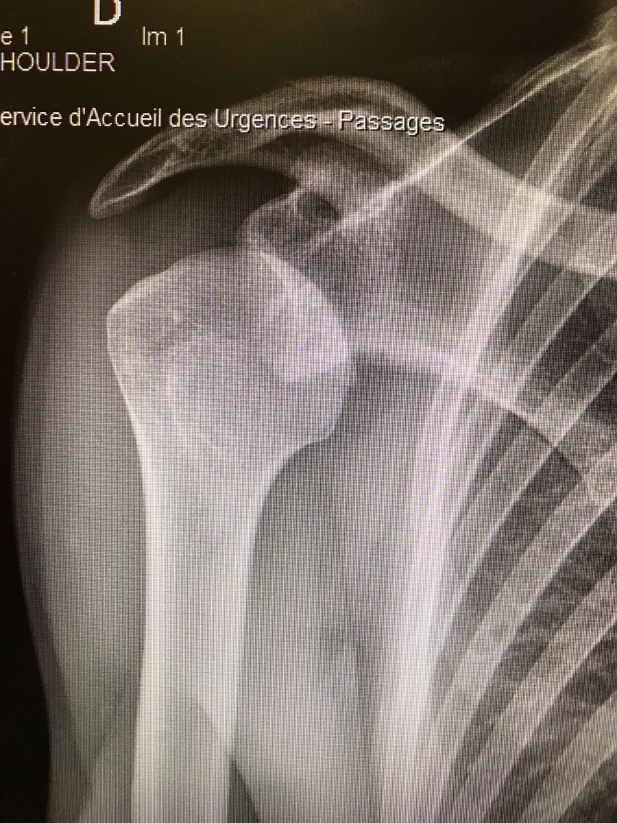 FXMoronval's tweet photo. 1ère réduction de luxation d’épaule sous hypnose ! 
Aucune douleur du patient ! 👍🏻
Je suis trop content ! 😄 https://t.co/5kBim1q5Kj