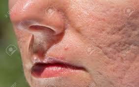 BBeautifulskin's tweet photo. You don't have to live with acne scars. Talk to us about microneedling. Call us at 316-201-1205. https://t.co/RHQCZOTpXs