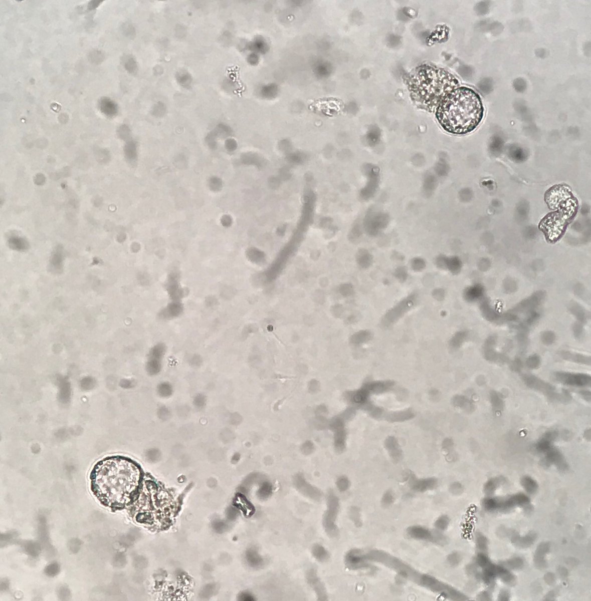 Decoy cells due to BK Polyomavirus in the urine of a kidney allograft recipient. Fresh and unstained urine sediment. Yes, we can correctly identify this kind of cell during routine urinalysis. #nephrology #kidneytransplantation #urinalysis #urinesediment