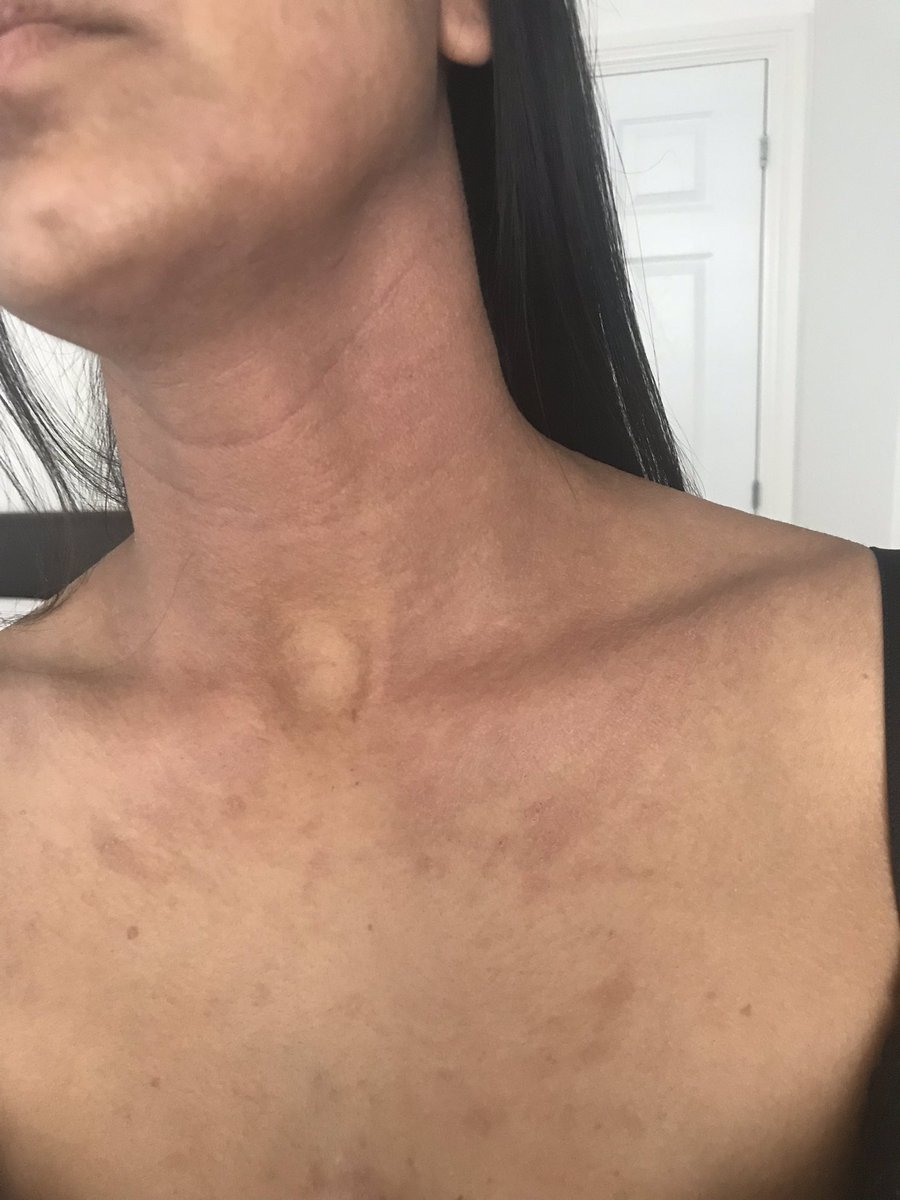 Pollen allergy is one I’ve found challenging more than any other in the past couple years and currently finding no real relief for the eczema. It becomes red, inflamed, anti histamines don’t work and gosh am I tired. This + standard expectations of life =😓. Any tips?