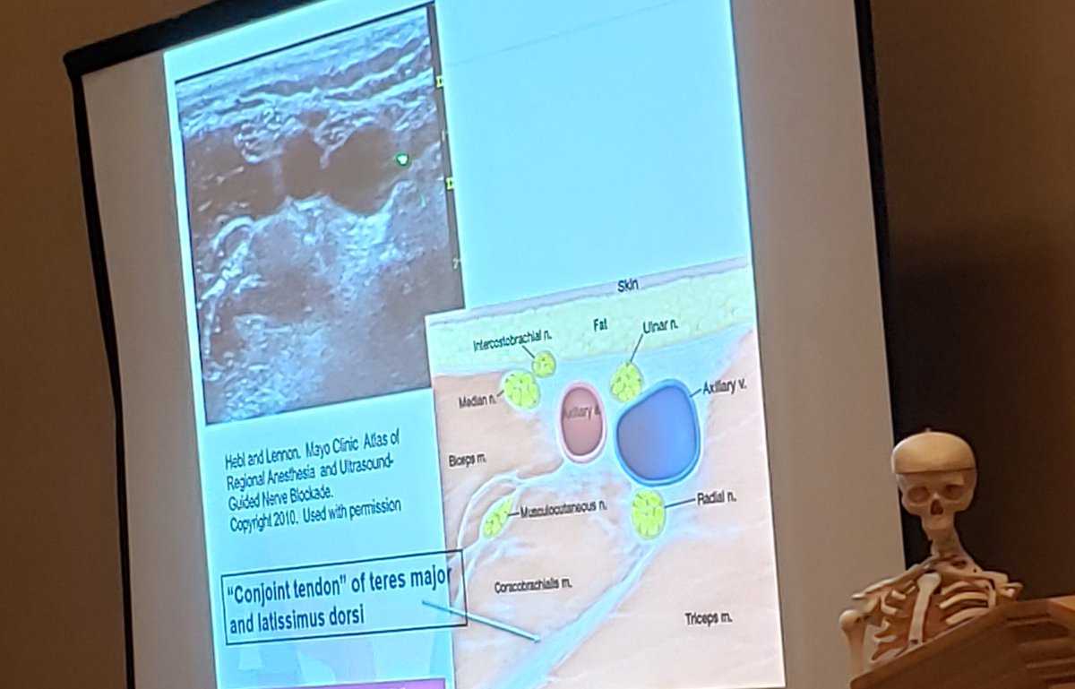 EMARIANOMD's tweet photo. The axillary block isn't dead - great reminder from @rljohnsonmd with helpful pearls like identifying the "conjoint tendon" to make it work #ASRASpring19 https://t.co/9Gt1r8alDt