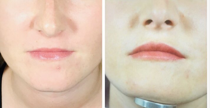 Medicetics's tweet image. Thought about getting lip fillers? Healthista writer Olivia Hartland-Robbins wanted a subtle effect that balanced out her face, rather than a ‘done’ effect – here’s what happened when she had her lips filled @medicetics with lips specialist Dr Sepi. Can you spot the difference?