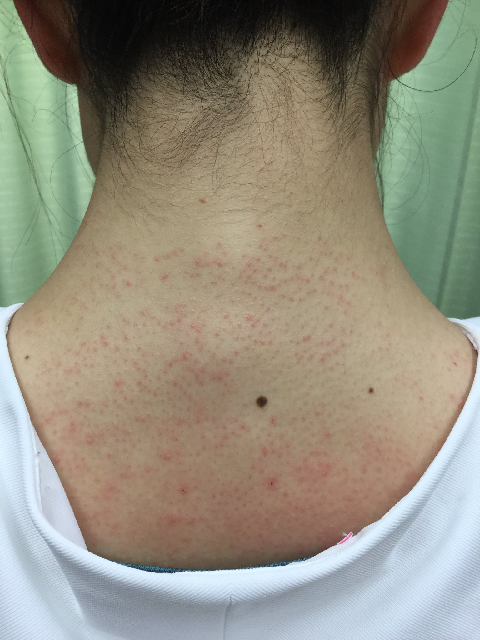 تويتر 白鳥皮フ科クリニック على تويتر 背中のちょい見え脱毛 脱毛直後です 赤いところが毛があったところ 結構生えてます 白鳥皮膚科 白鳥メディカルエステ 首筋脱毛 医療脱毛 T Co 6w1bp6svu5