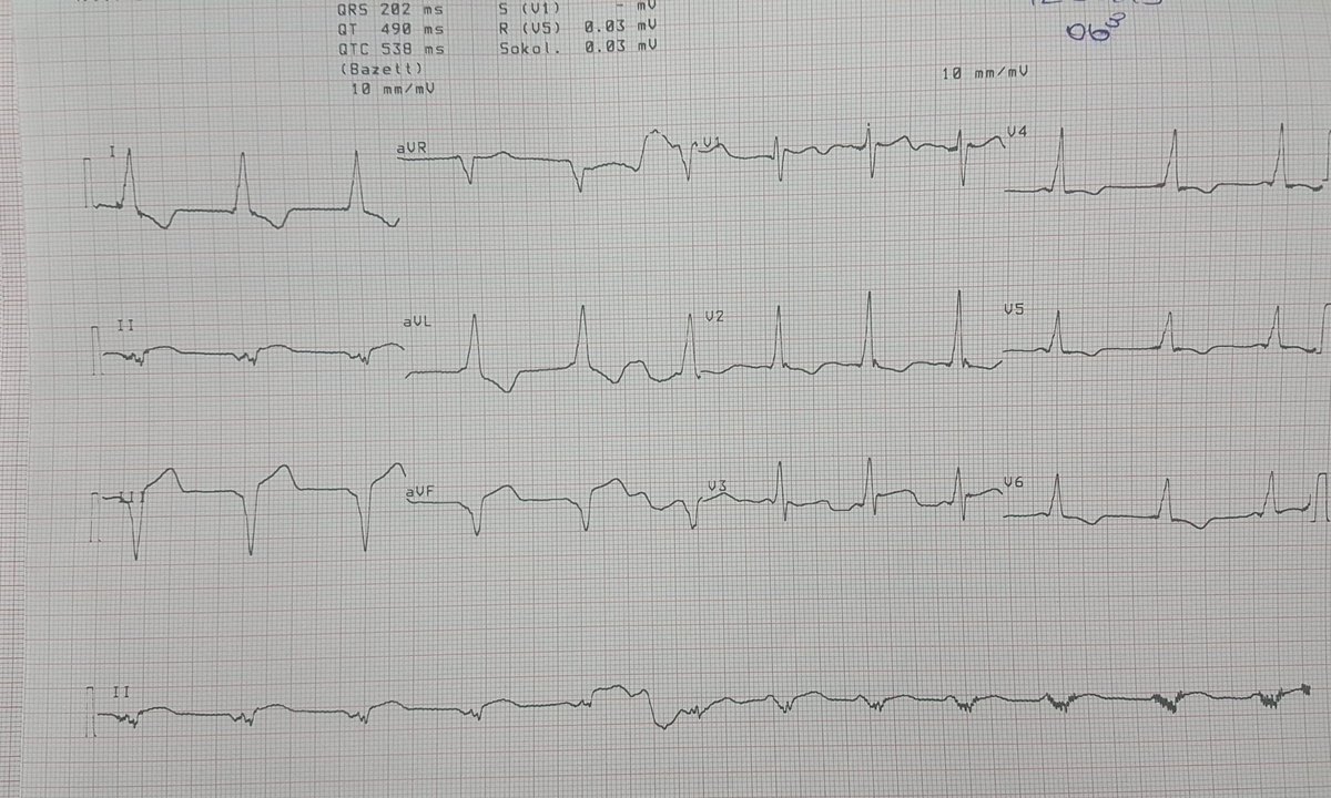 AlperDra's tweet photo. 20 yo sudden death survivor woman. She was taking thyroid hormone replacement theraphy bc of hypothroidism. #EPeeps @MDTolgaAksu @CarinaHardy4 @U_Cnplt @can_yontar @SchakrabartiEP @drercardio @Firaszahwe https://t.co/ViKO6c0zCx