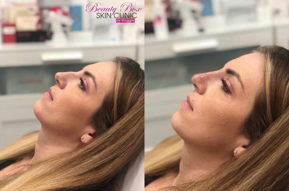 BeautyBoxMaggie's tweet photo. 30 minute nose job? Go on then 💉💉

Book your liquid rhinoplasty with us today! Call Maggie on 07424716505💋

#nosejob #liquidrhinoplasty #nosegoals #Essex https://t.co/12IjioWDNn