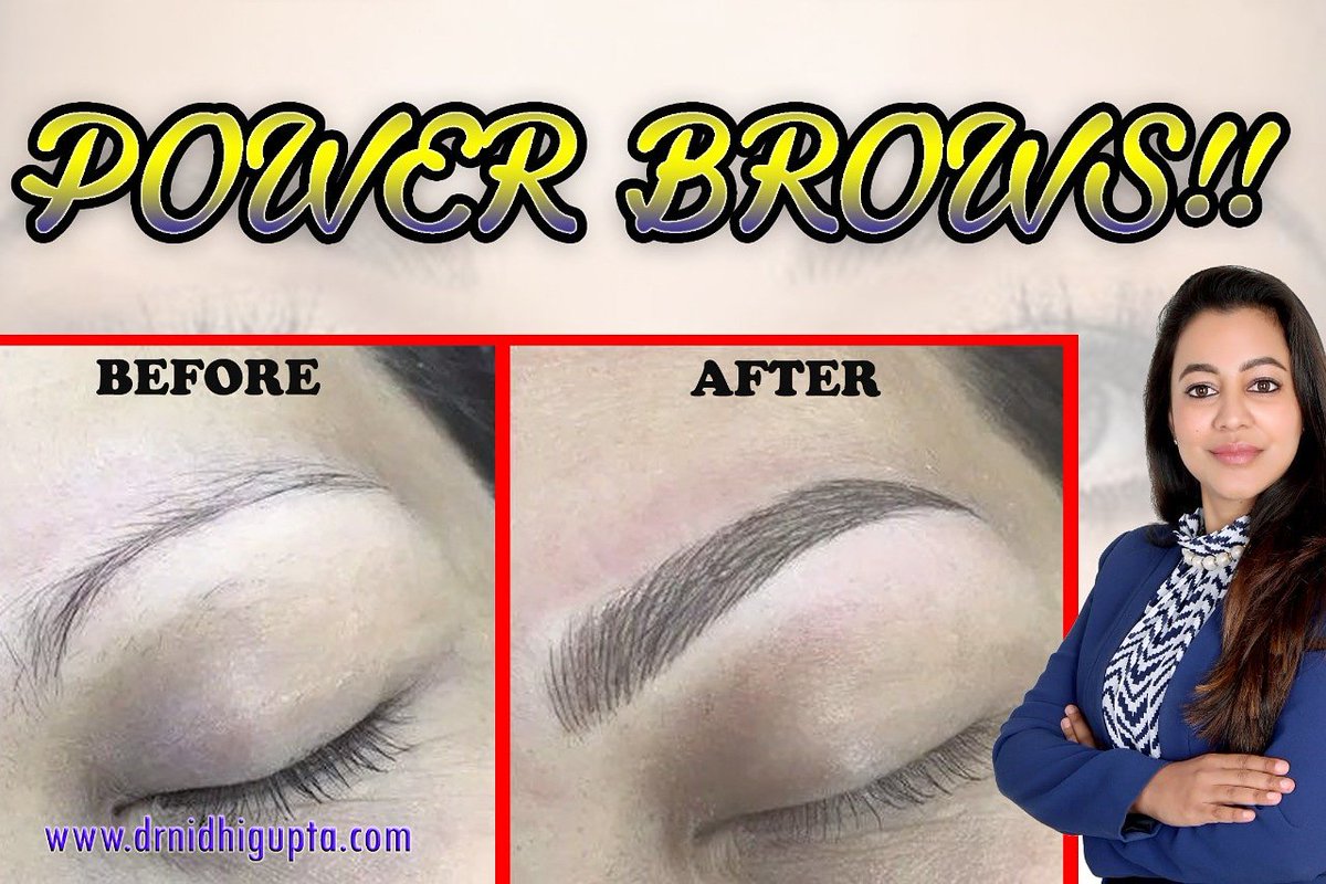 DRNIDHIGUPTA_MD's tweet image. *POWER BROWS!!*
Never Underestimate the Power of an Eye Brow!!
for more Info
visit our website drnidhigupta.com
Post Your query at info@drnidhigupta.com.

#Powerbrows #beauty #DrNIdhiGupta
 #Reviveyourbeauty #Womenpower #MIcropigmentation #Microblading #Semipermanentmakup