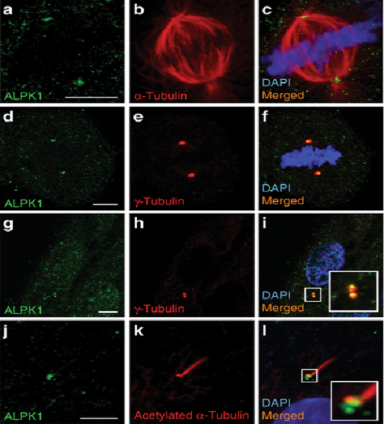 A mutational hotspot in ALPK1 underlies ROSAH syndrome, a multisystem autosomal dominant disorder, and suggests a role for the kinase in centrosomal cilia function #openaccess go.nature.com/2Gfrf50