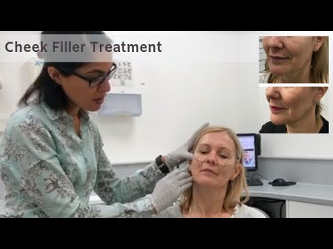 If you dislike your jowls maybe this could help you too youtu.be/wMqEuHxGJ5I #cheekfillers #jawfiller #facialaesthetics