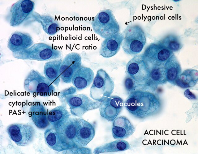 Creating Salivary Gland Cytopathology review flash cards for our 4th years— I’m all about pictures with concise descriptors. Easy to digest and easy to share! 

#pathology #teach #learn #share #pathtweetaward #medicine #histology #cytology