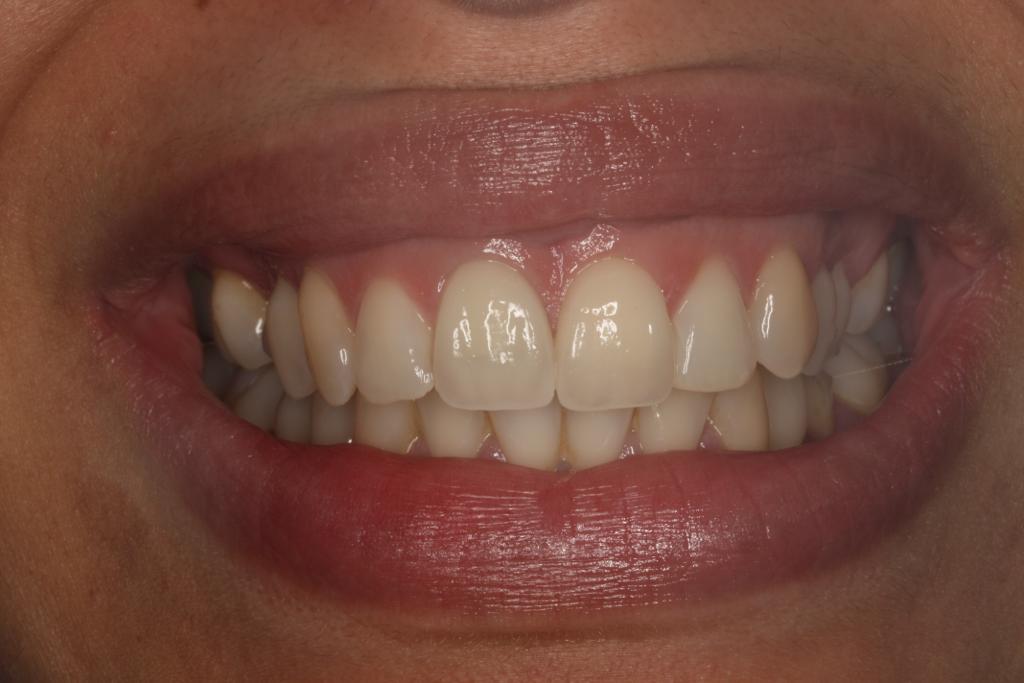 The crowns on these two front teeth were provided here at Primley Park Dentistry 10 years ago. 😁🦷

Today they still look as beautiful as the day they were fitted!

#Throwback #CeramicRestoration #Dentist #Leeds #Yorkshire #Crowns #KeepSmiling