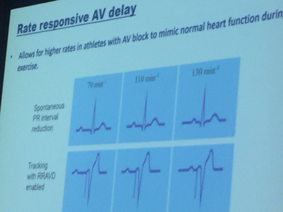 Sanjay Sharma (@ssharmacardio) on Twitter photo <a href="/DrAneilMalhotra/">Prof Aneil Malhotra</a> Pacing athletes 1. support the sinus node; 2. Minimise ventricular pacing (dessynchrony) when possible; 3. encourage normal AV conduction by varying AV delay #Europrevent 2019 <a href="/DrAneilMalhotra/">Prof Aneil Malhotra</a> Pacing athletes 1. support the sinus node; 2. Minimise ventricular pacing (dessynchrony) when possible; 3. encourage normal AV conduction by varying AV delay #Europrevent 2019