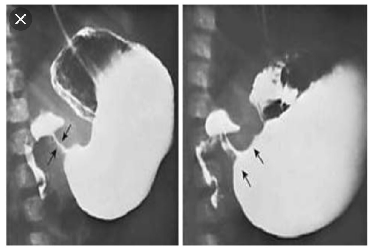 Pyloric Stenosis Upper Gi Series