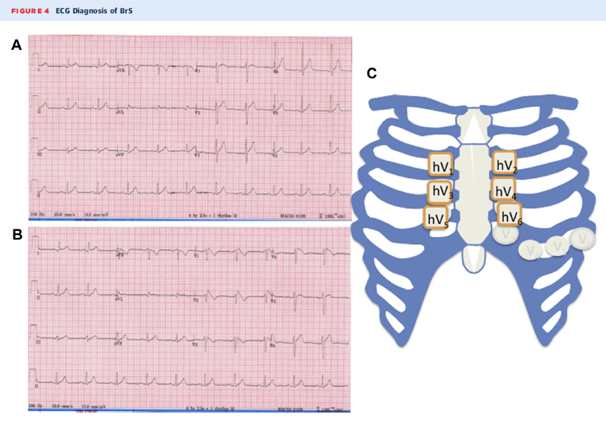 Correct lead placement #brugadapattern #brugadasyndrome
Want to know more? goo.gl/AbCoSc
En plena campaña apoyada por #TeamESP #brugadafoundation #SacaLaLengua #pirulate #síndromedeBrugada #feelthebeat #JACCCEP #SuddenCardiacDeath #SCD #arrhythmias #genetics #BrS #SCN5A