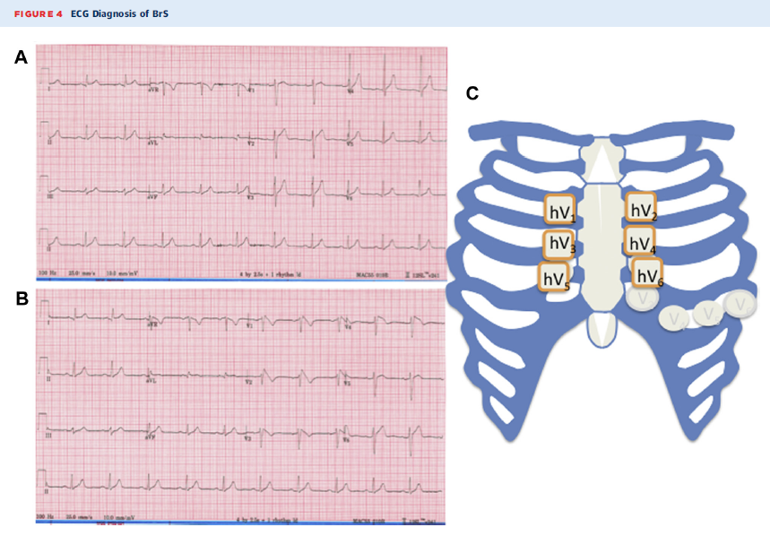 Correct lead placement #brugadapattern #brugadasyndrome Want to know more? goo.gl/AbCoSc En plena campaña apoyada por #TeamESP #brugadafoundation #SacaLaLengua #pirulate #síndromedeBrugada #feelthebeat #JACCCEP #SuddenCardiacDeath #SCD #arrhythmias #genetics #BrS #SCN5A