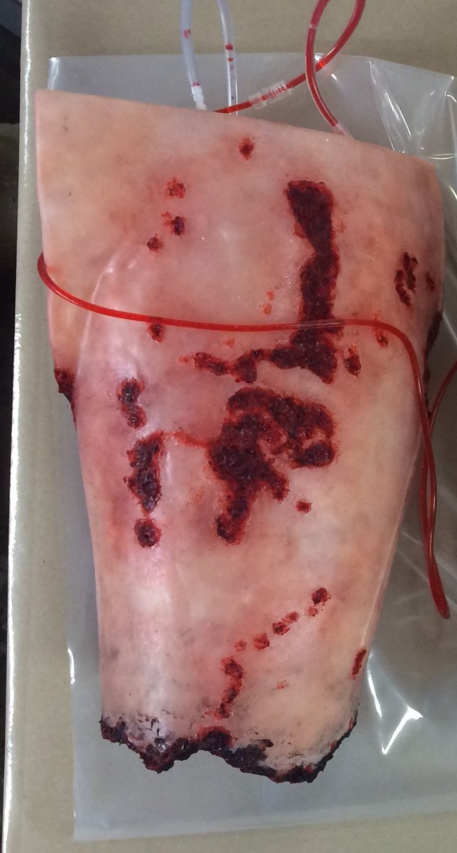 Final stages prototyping SAM4 series models for point-of-wounding <C> external haemorrhage control from pelvic, buttock and lower limb trauma. See the visible effectiveness of proximal pressure at the groin, wound packing, pelvic binder and tourniquet application. Coming soon!