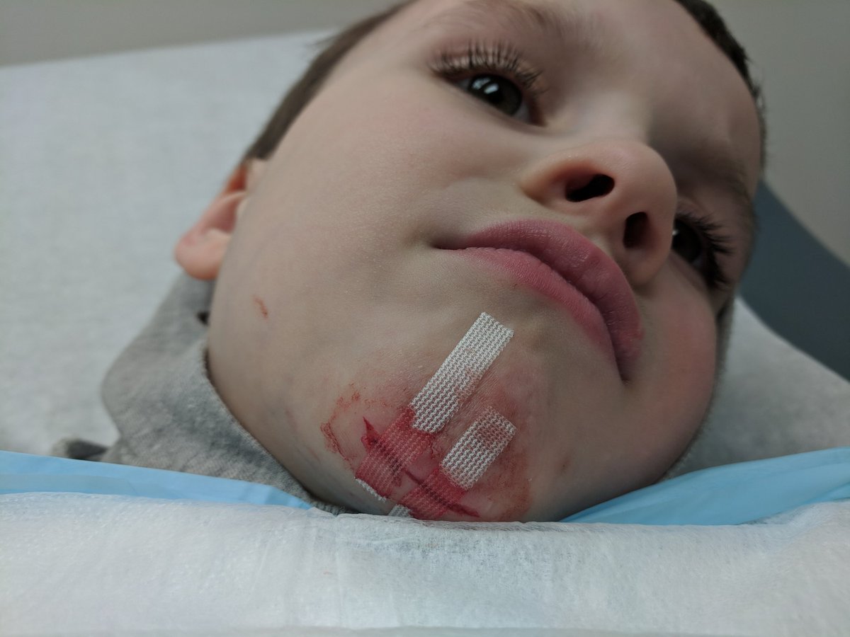 Prof_NoFace's tweet photo. Not the best way to end PAX, but when I asked him what part of the whole weekend he hated most (including getting 3 stitches in his face), he still picked "having to wait in line" so it doesn't seem to have dampened his spirits any. #chipofftheblock #PAXEAST #postpax https://t.co/94y299X0KU
