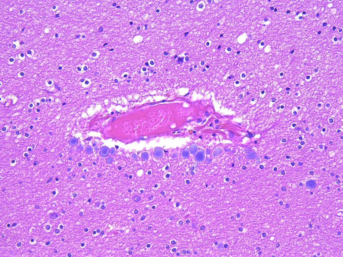 Patholwalker's tweet photo. Corpus amylacea. Cerebrum, HE and Kluver-Barrera's stain.  #Histology #neuropath https://t.co/vOPMoUvi5T