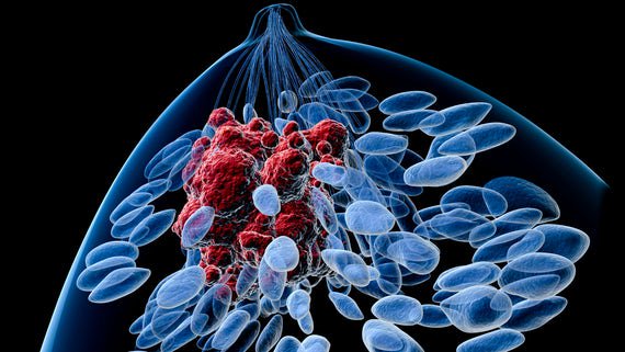 breastCRA's tweet photo. A potential treatment for therapy-resistant breast cancer patients has been uncovered by researchers at Cardiff University. To read further, click below https://t.co/AftH0dneRZ https://t.co/95ojUhKh89