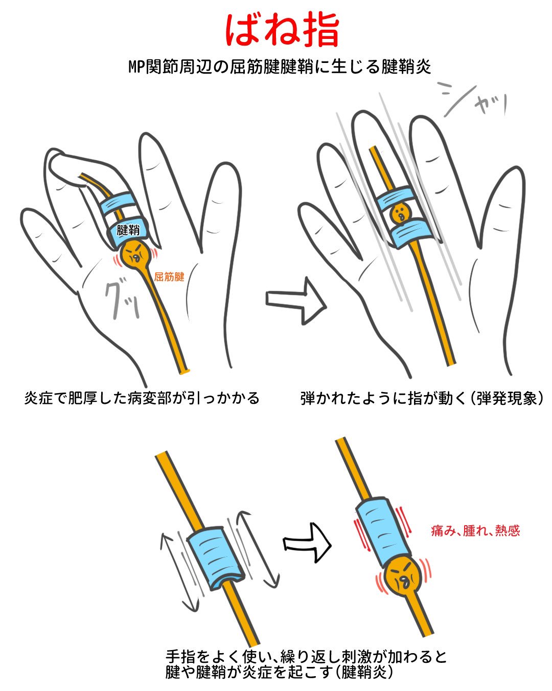 ゴロ 解剖生理イラスト בטוויטר イラストで分かる ばね指 ゴロ 解剖生理イラスト בטוויטר イラストで分かる ばね指
