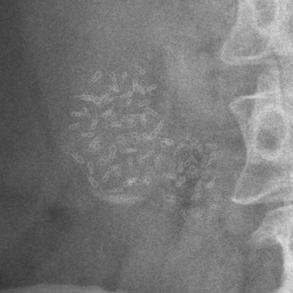 RadiologySigns's tweet image. Zoomed radiograph of the right mid abdomen in a 70yo woman. What is this scary but rare entity? ANSWER: bit.ly/2FF5LOD #foamrad #foamed #medicine #surgery via @Radiopaedia