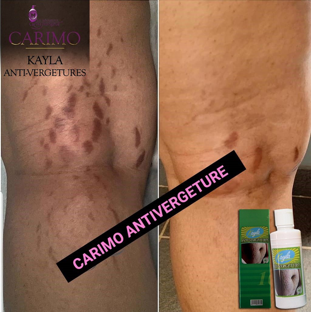 labocarimo's tweet photo. Stooooop aux vergetures! la crème KAYLA ANTI-VERGETURES ! La solution !
Avec la crème KAYLA ANTI-VERGETURES, vos vergetures disparaîtront !!!!
Prix : 15 000 Fcfa
Nb : Prix en vigueur au Cameroun
CARIMO, l'audace d'être soi !
#LCM #CARIMO #GETADDICTED https://t.co/dkCF9av7Hb