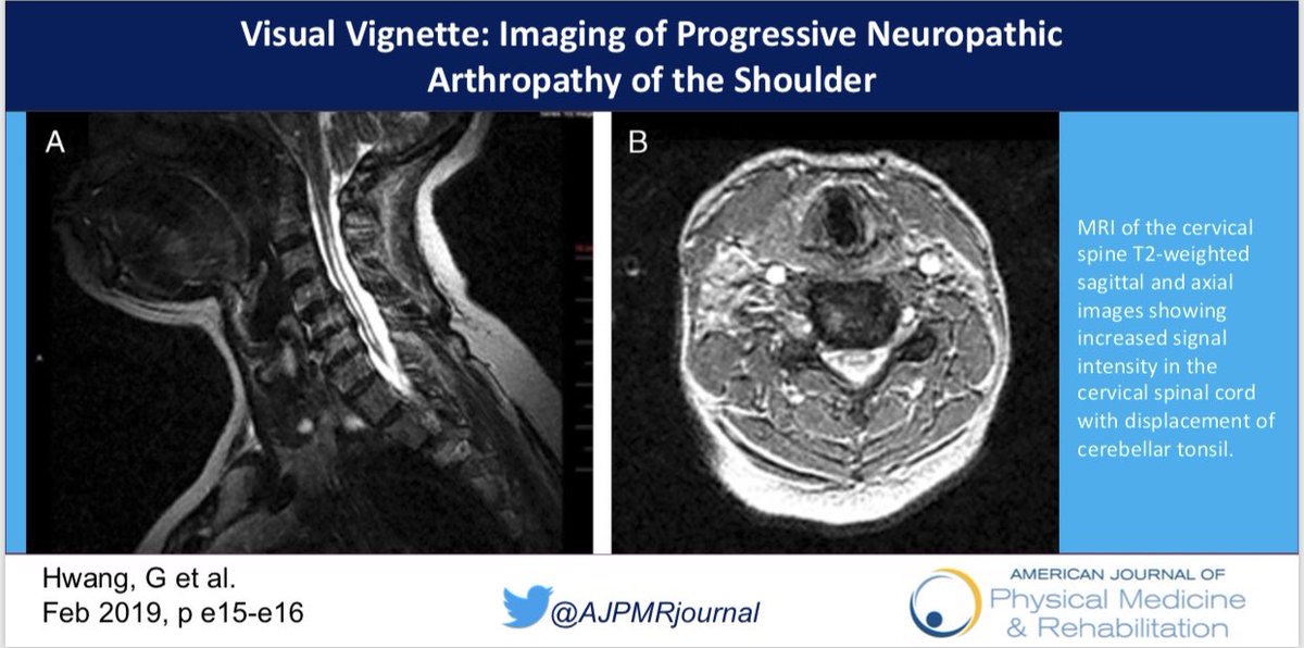 AJPMRjournal's tweet photo. #VisualVignette - Imaging of Progressive Neuropathic Arthropathy of Shoulder

Featuring @EinsteinMed @MontefioreNYC authors Gloria Hwang, MD, Reina Nakamura, DO &amp; Se Won Lee, MD - #MSKrehab #Physiatry #Rehab #ShoulderPain

https://t.co/QIrPBEibqA https://t.co/WnylW4TKVH