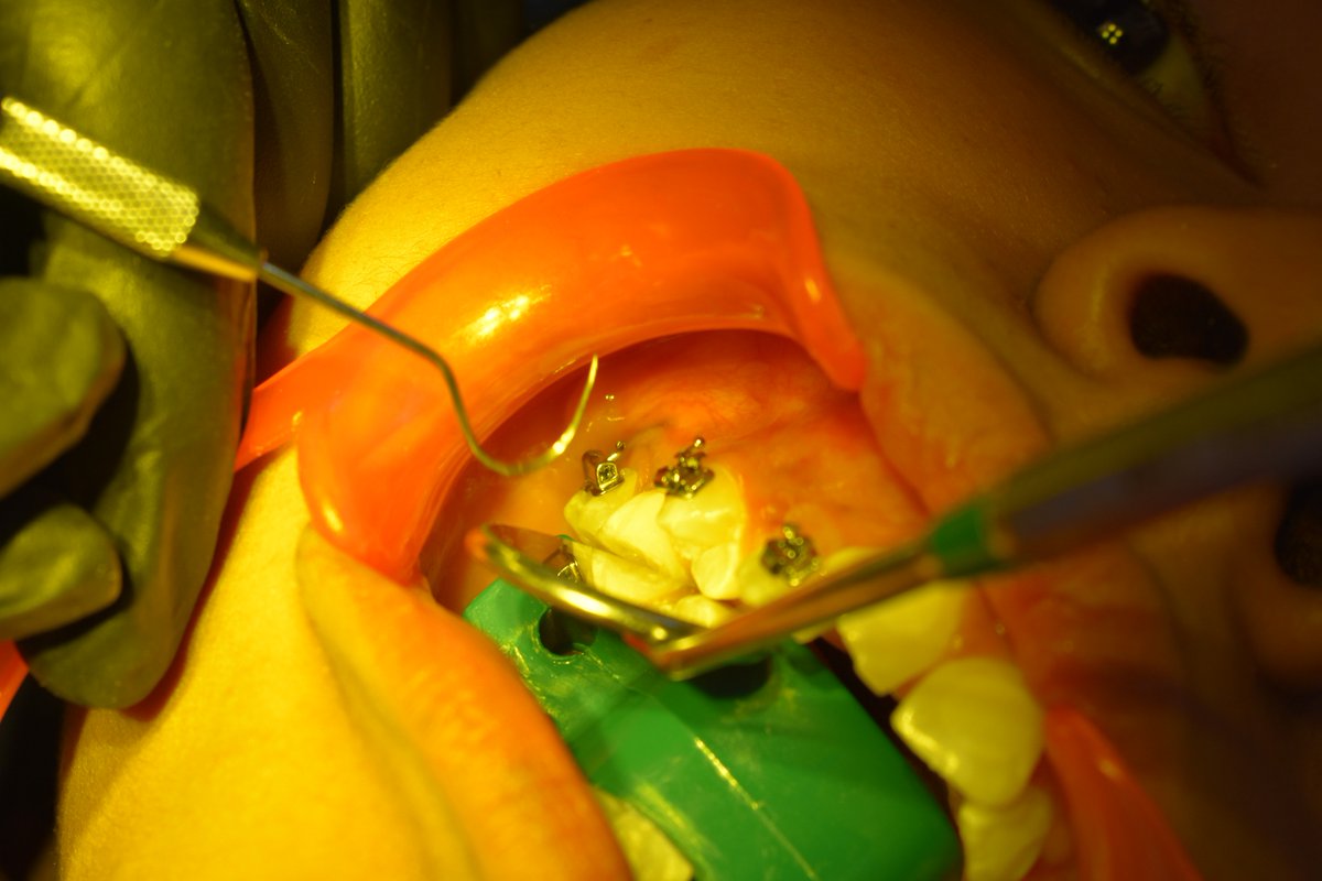 DECIENESUNAM's tweet photo. Del 25 al 27 de marzo, la @ENESUNAMLEON en colaboración con Orthodontics Guanajuato ofrecieron el curso “Sistema CCO" impartido por el reconocido ortodoncista colombiano, Dr. Andrés Giraldo Mejía.
#OrgulloENESLeón #CCOSystem #OrtodonciaENESLeón
https://t.co/uBzmNbGVjC https://t.co/AnZlyfXmDk